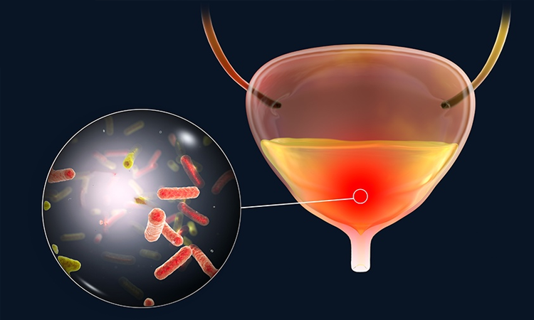 โรคกระเพาะปัสสาวะอักเสบเป็นหนึ่งในโรคทางเดินปัสสาวะที่พบบ่อย
